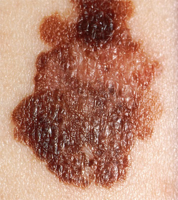 malignant-melanoma