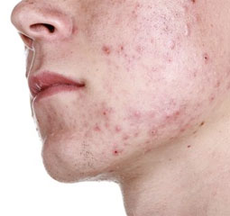 teenage-acne