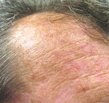 actinic-keratoses