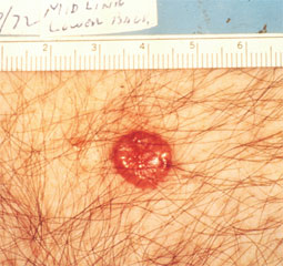 basal-cell-carcinoma