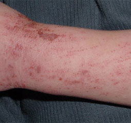 dermatitis