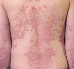 Psoriasis